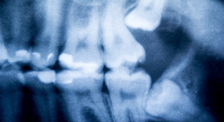 歯科用CTで抜歯の判断をします