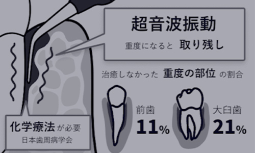 超音波振動のみによる治療