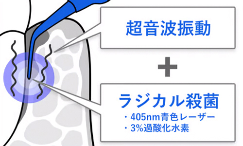 超音波＋ラジカル殺菌による治療