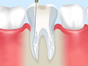 歯を根から治す根管治療