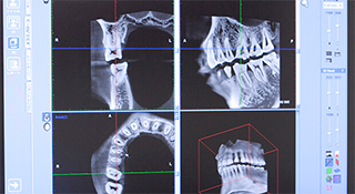 特徴03　精密な検査が可能な歯科用CT採用