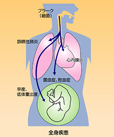 全身にも悪影響を与えます