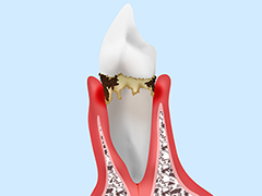 軽度歯周病