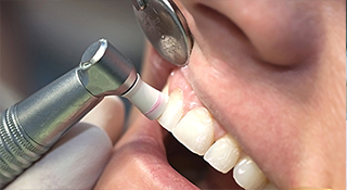 PMTC（プロフェッショナル・メカニカル・トゥース・クリーニング）