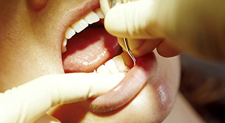 歯周ポケットクリーニング