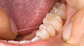 デンタルフロスによるケア