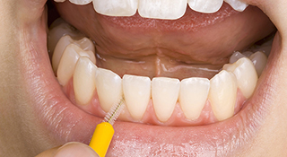 歯間ブラシによるケア